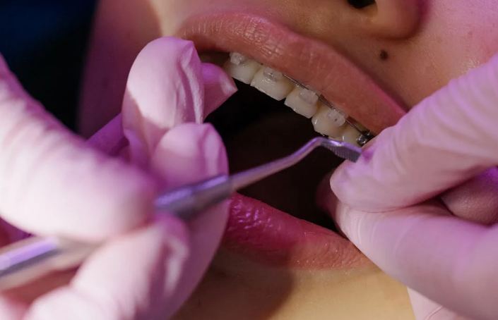 Does a Health Policy Cover Dental Treatment in India?